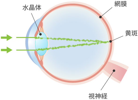 白内障の眼