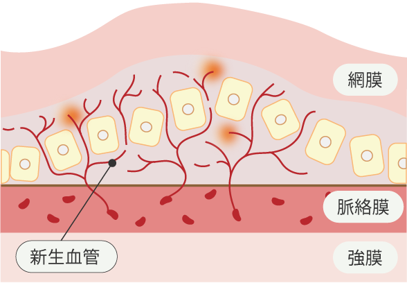 滲出型加齢黄斑変性