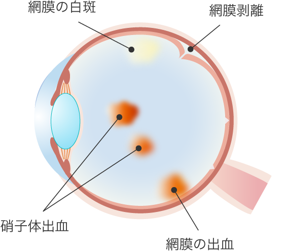 糖尿病網膜症の症状